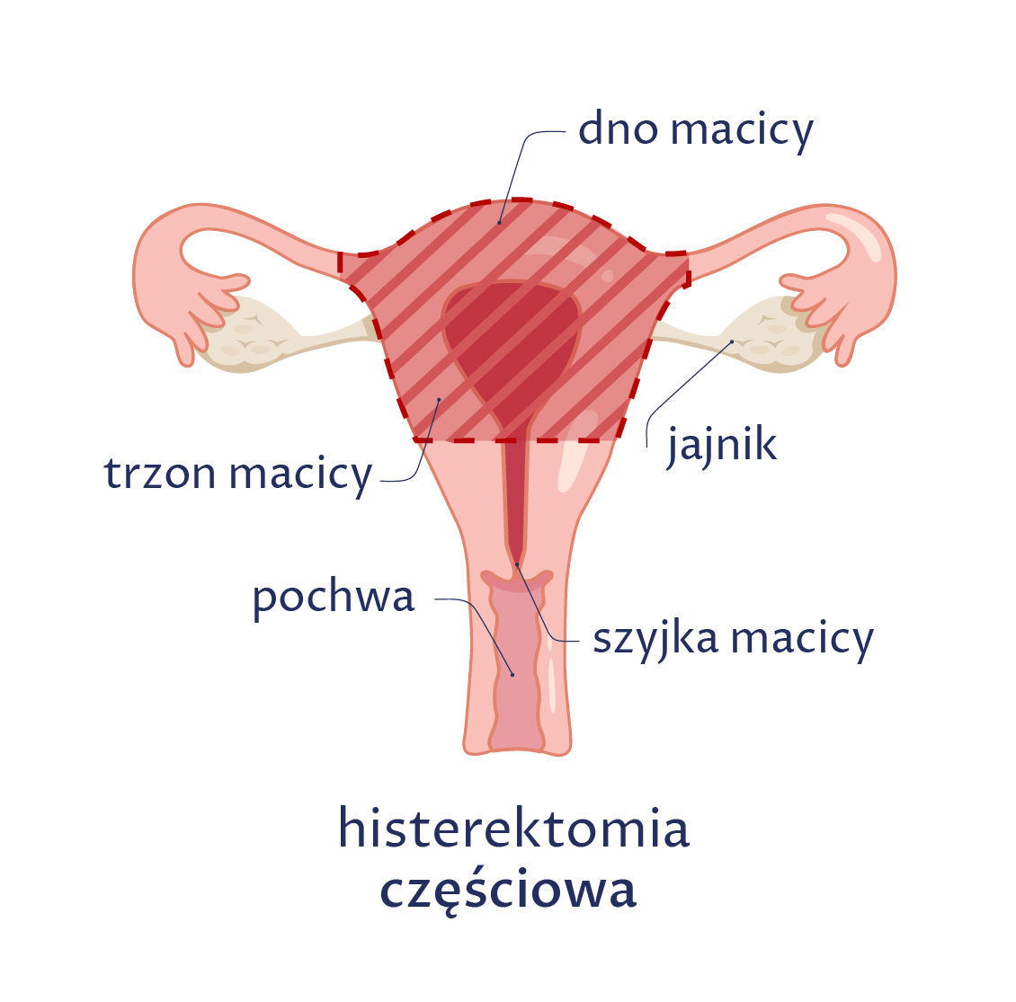 Rysunek przedstawia histerektomię częściową, podczas której wycina się tylko trzon macicy, a pozostawia jajniki, jajowody, całą pochwę, szyjkę macicy i przymacicze.