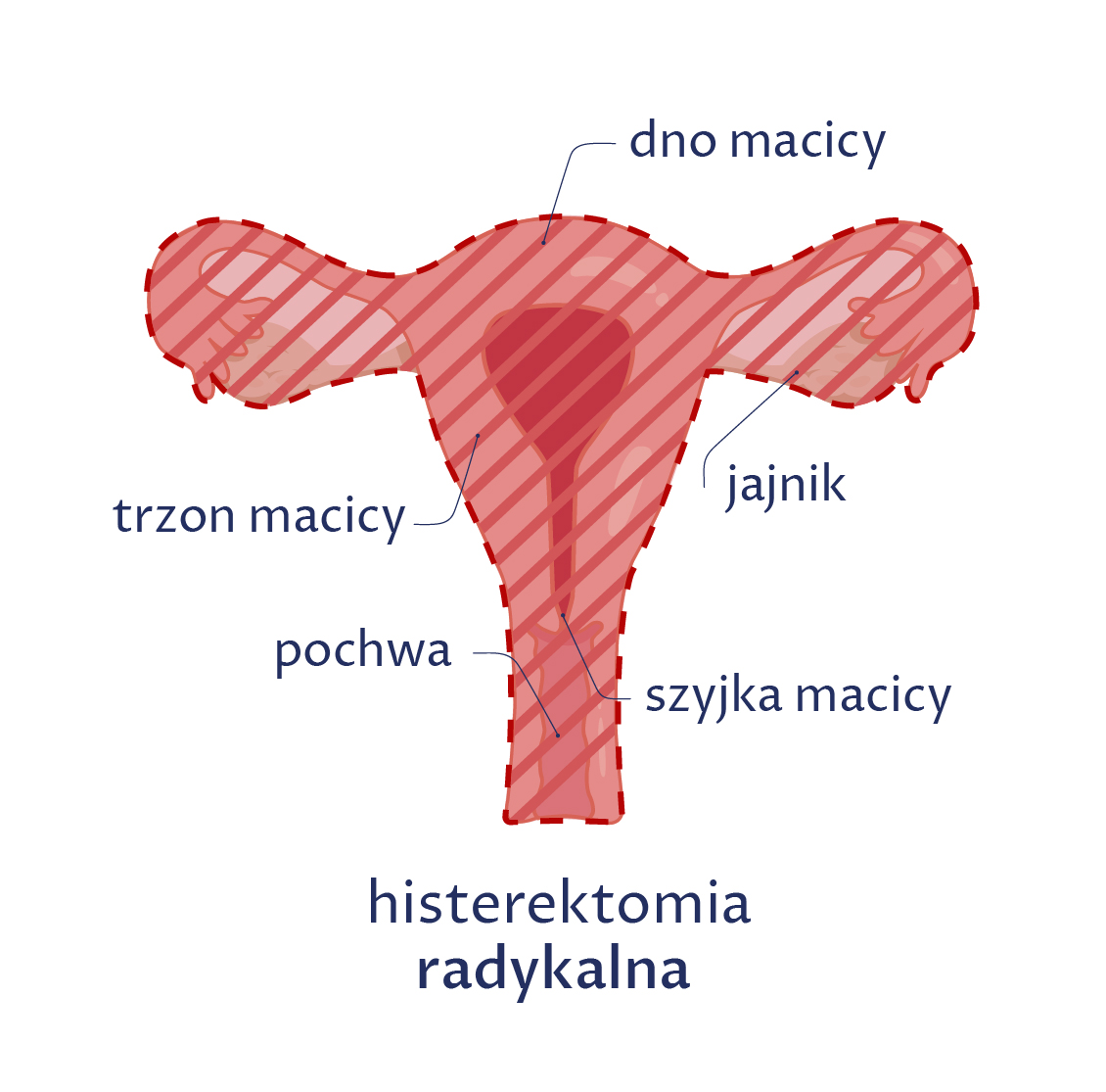 Rysunek ukazuje histerektomię radykalną z usunięciem górnej części pochwy, podczas której wycina się macicę (szyjkę i trzon), jajniki, jajowody, górną część pochwy i przymacicze.
