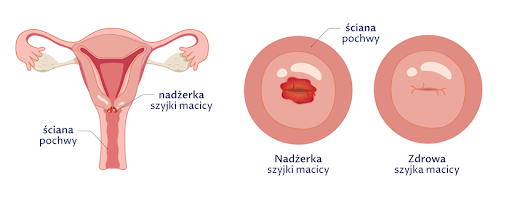 grafika przedstawiająca jak wygląda nadżerka szyjki macicy