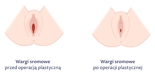 Rysunek przedstawia stan warg sromowych przed i po zabiegu labioplastyki