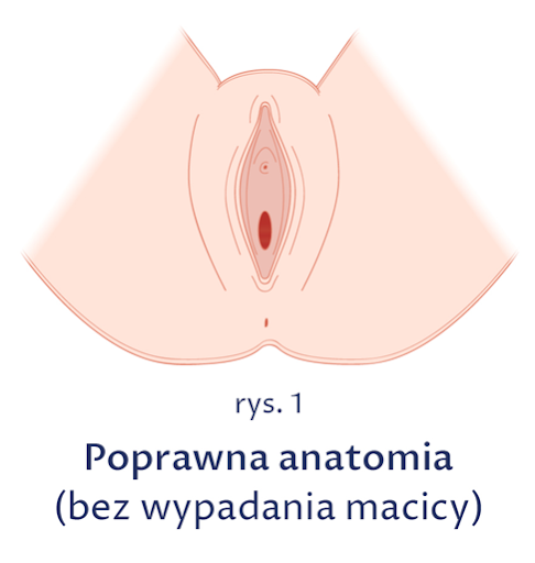 Wypadanie macicy - prawidłowa anatomia: rysunek przedstawia jak prawidłowy stan i wygląd damskich narządów płciowych, kiedy nie dochodzi do ich obniżenia i wypadania