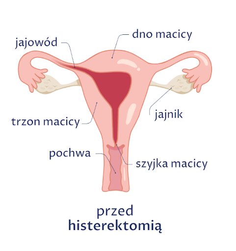Stan żeńskiego układu rozrodczego przed histerektomią -na rysunku jajniki, jajowody, macicę (szyjkę i trzon), przymacicze i pochwę 