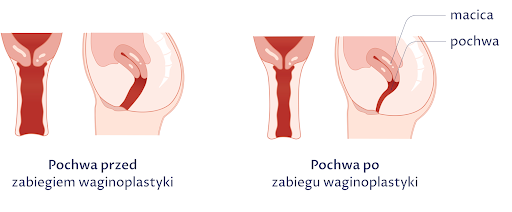 Rysunek przedstawia stan pochwy przed i po zabiegu waginoplastyki.